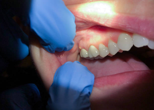 Best Knocked-Out Tooth (Avulsed Tooth) Treatment in Ovilla, TX