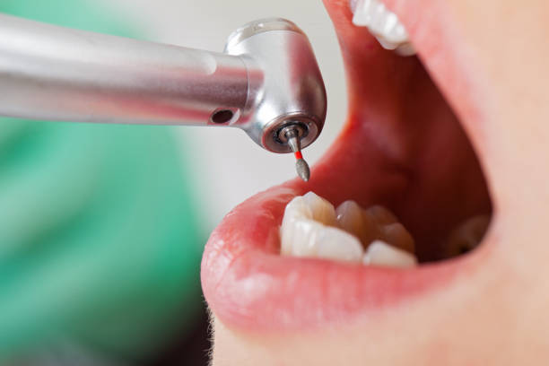 Best Lost Filling or Crown Replacement in Ovilla, TX